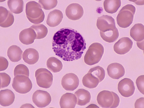 Research showing an increased presence of eosinophilia
