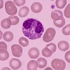 Research showing an increased presence of eosinophilia